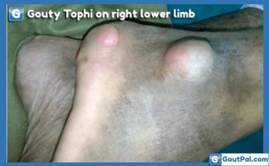Gouty Tophi On Right Lower Limb