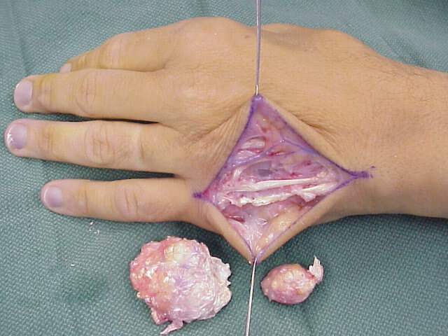 Tophi Removal From Hand photo