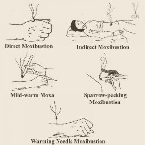Moxibustion in Gout and Acupuncture
