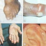 Why are tophi important to gout sufferers?