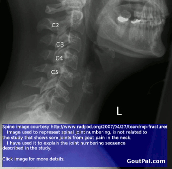 Neck Pain With Gout Xray Diagram