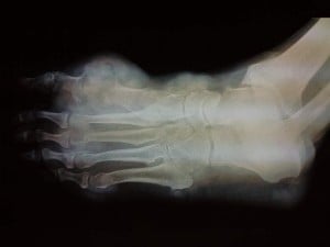 Left Foot Tophi Xray Photograph