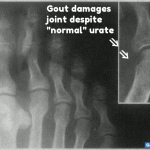 Gout Without Hyperuricemia