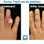 Tophi: Illustrated Reference Guide