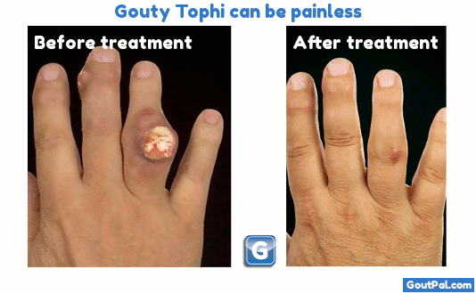 Gouty Tophi Can Be Painless Photograph