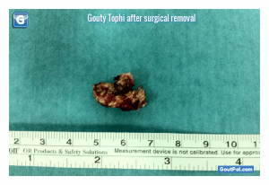 Gouty Tophi After Surgical Removal Photo