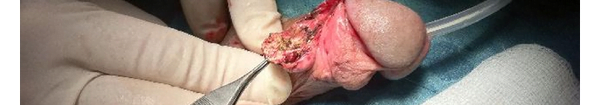 Surgical Removal Of Gouty Tophi From Penis photograph.