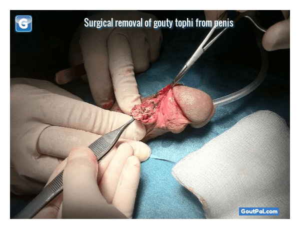 Surgical Removal Of Gouty Tophi From Penis photograph.