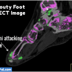 Running With Gout - Beware Foot Tendon Damage