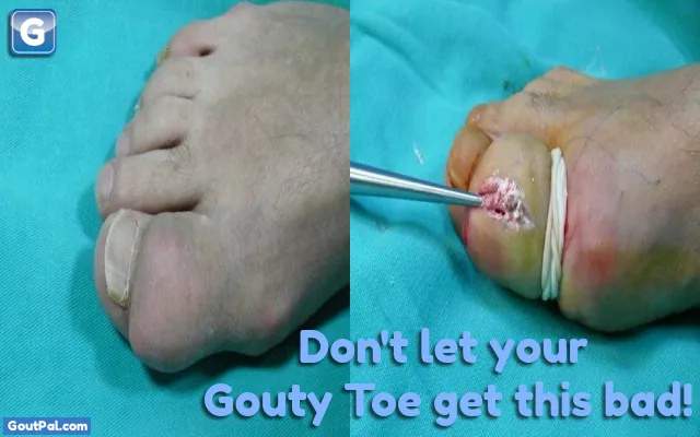 Toe Tophi Surgery on Gout Victim
