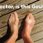 Doctor, Is This Gout?