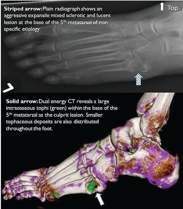 icd 10 gouty tophi