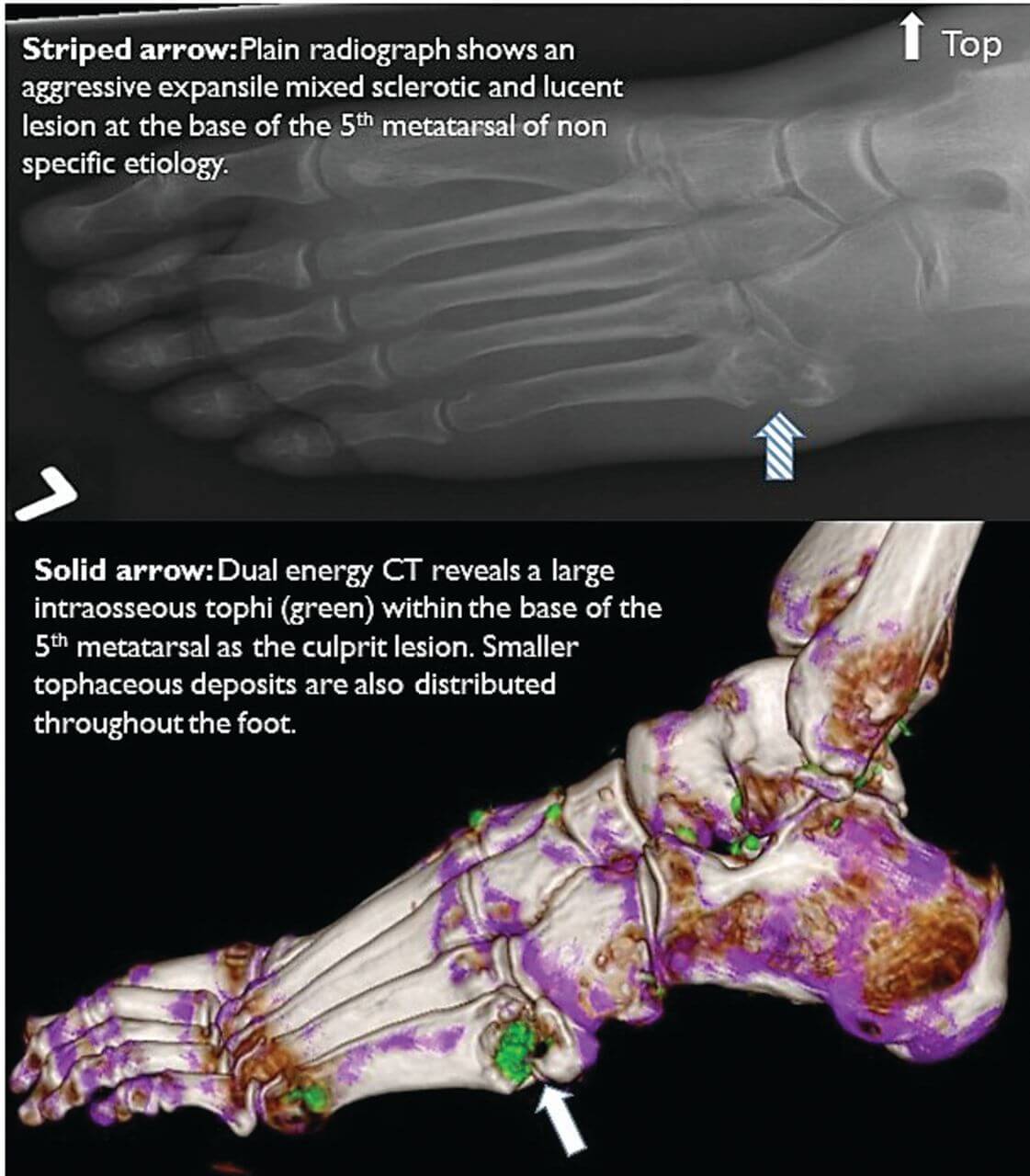 Gouty Tophi & Bone Erosion | GoutPal Gout Help