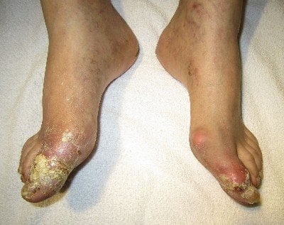 Understand the Symptoms of Gout photo