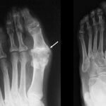 Gout, Bunion, or both X-rays