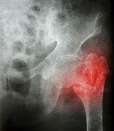 Gout and Hip Fractures X-ray | GoutPal Gout Forum