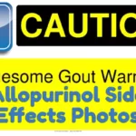 Warning: Photos of Allopurinol Side Effects