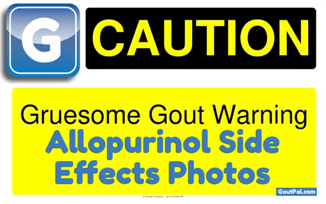 Warning: Photos of Allopurinol Rash