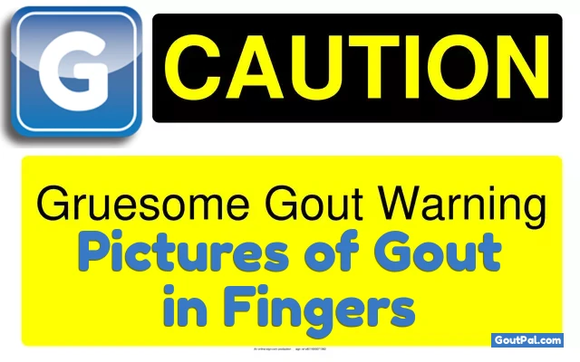 Pictures of Gout in Fingers Warning