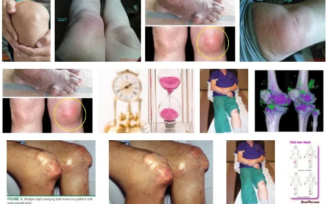 Gout Knees Picture Selection