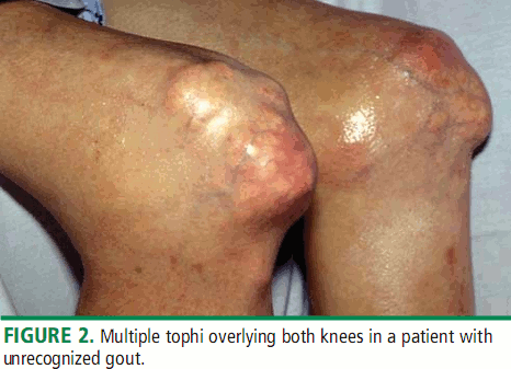 Undiagnosed Tophaceous Gout